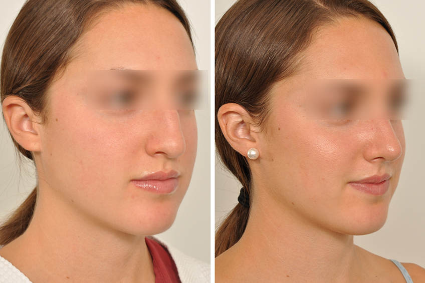 nose job Rhinoplasty